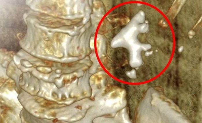 Hình ảnh chụp CT ghi nhận sỏi san hô kích thước lớn chiếm phần lớn bể thận trái, lan vào các đài thận, gây ứ nước. Ảnh: BVCC