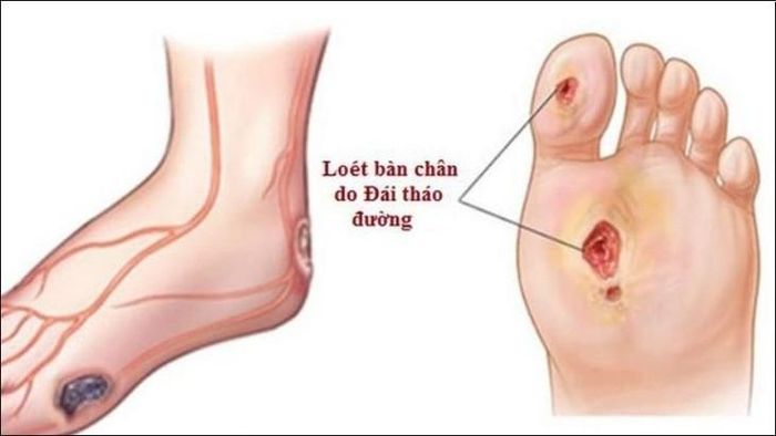 Việc chăm sóc bàn chân đúng cách góp phần bảo vệ bàn chân, hạn chế nguy cơ loét, nhiễm trùng. Ảnh M.H