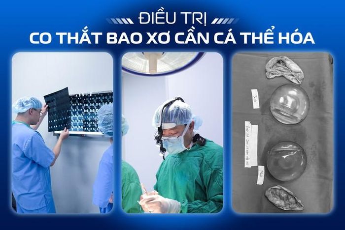Điều trị co thắt bao xơ cần cá thể hóa - Ths.BS Bùi Cường cho biết