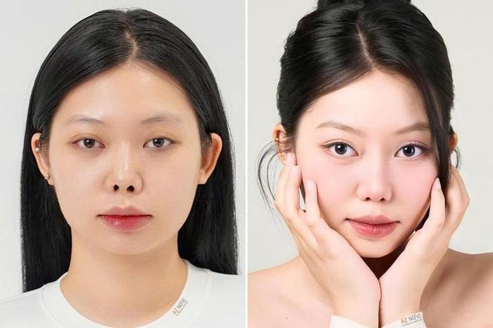 Chị T.L. trước và sau khi tái tạo mũi hỏng tại Phòng khám thẩm mỹ AZ NOSE.