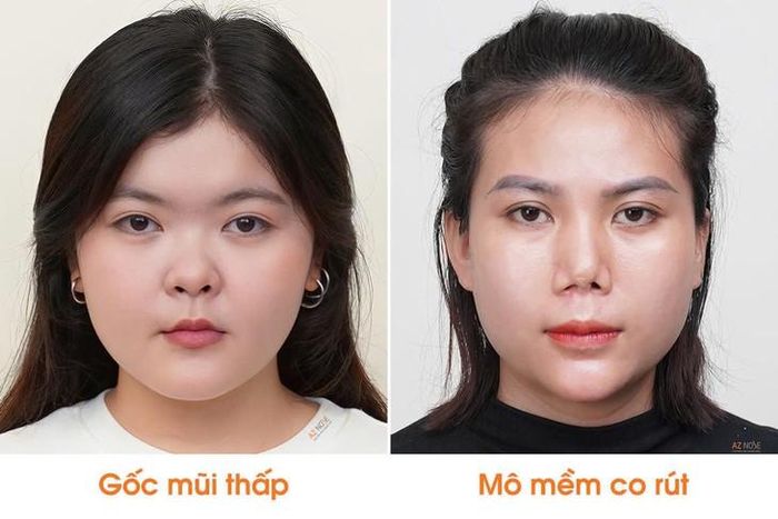 Chị T.A. (trái) và chị T.H. (phải) trước khi nâng mũi tại Phòng khám AZ NOSE.