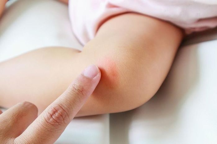 Trẻ nổi mẩn ngứa do nhiễm ký sinh trùng. Ảnh: Shutterstock.