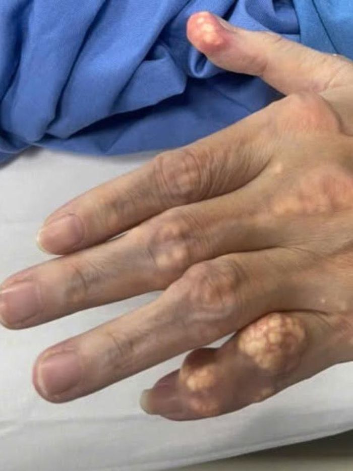 Gói thuốc và những tổn thương do gout của người đàn ông. Ảnh: BSCC.
