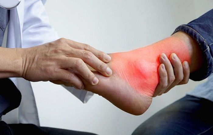 Chủ quan với đau khớp chân, thanh niên 20 tuổi ngỡ ngàng khi phát hiện mắc gout.