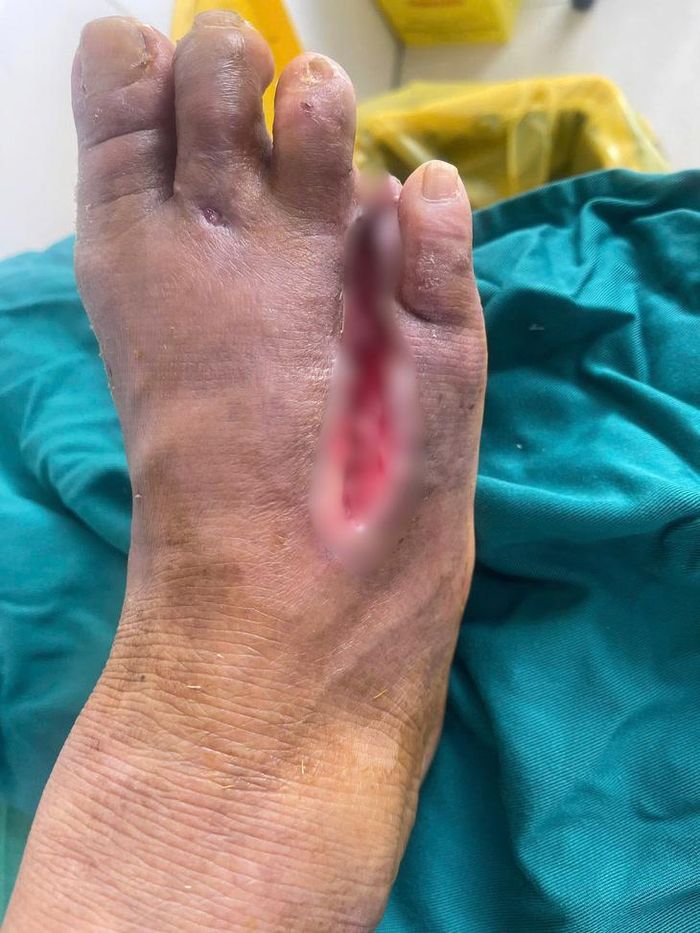 Sau quá trình điều trị, diện vết thương thu hẹp đáng kể, nền vết thương có mô hạt tốt, quá trình liền thương tiếp tục tiến triển thuận lợi. Ảnh: B.V.