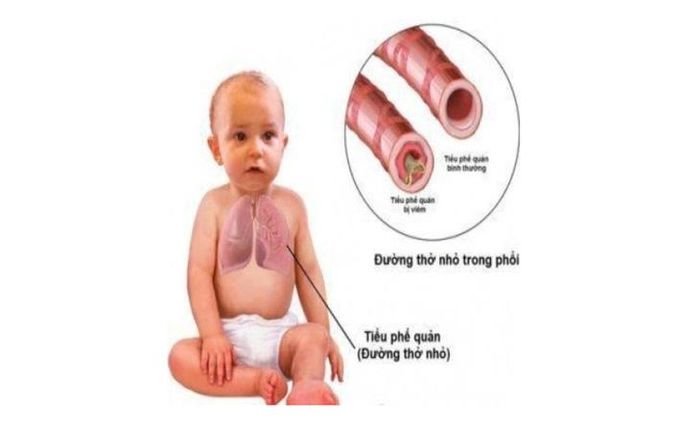 Viêm tiểu phế quản cấp là bệnh lý hô hấp thường gặp ở trẻ nhỏ, đặc biệt trẻ dưới 2 tuổi.