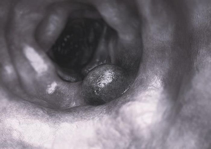 Khối u trực tràng, khối u phổi và 39 polyp được phát hiện cùng lúc ở người đàn ông 55 tuổi sau một tuần đi ngoài ra máu. Ảnh minh họa: Saintjohnscancer.