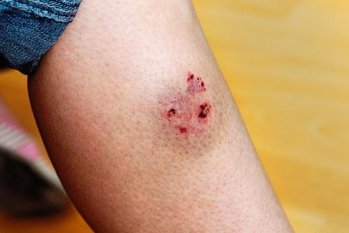  Tiêm phòng vaccine và huyết thanh là biện pháp phòng ngừa bệnh dại. Ảnh: Shutterstock.