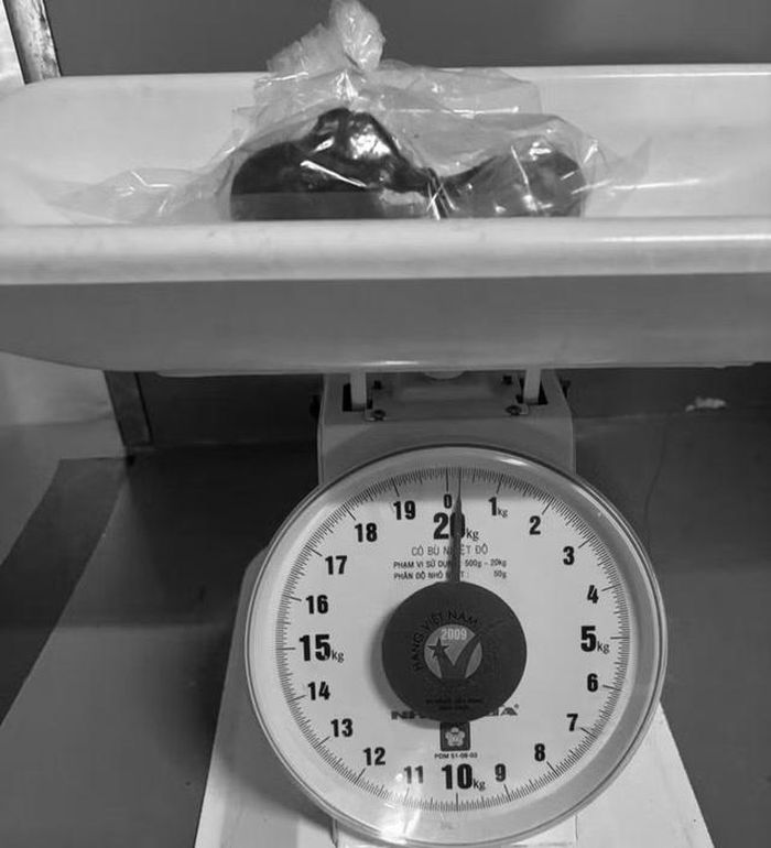 Khối tóc nặng khoảng 0,25kg được lấy ra trong bụng của bé gái 5 tuổi ở Cà Mau.