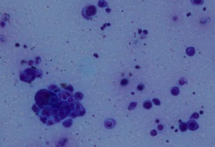 Xét nghiệm tế bào học từ tổn thương mụn nước trên mặt ghi nhận hình ảnh tế bào gai lệch hình và tế bào đa nhân khổng lồ. Ảnh: Bệnh viện Da liễu Trung ương.