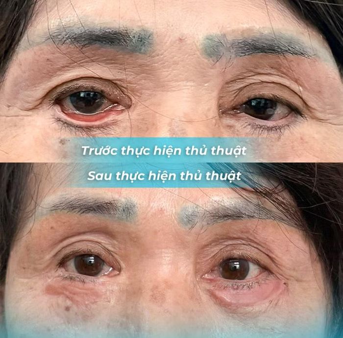 Hình ảnh mắt bệnh nhân trước và sau nhập viện.