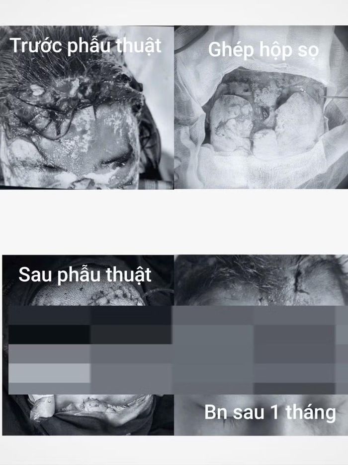 Ca phẫu thuật kéo dài hơn 5 giờ đồng hồ. Ảnh: Bệnh viện cung cấp