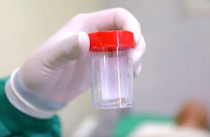 Dị vật mảnh xương cá sau khi lấy ra từ phế quản bệnh nhân.BVCC.