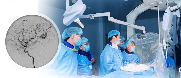 Hai trẻ vỡ dị dạng mạch máu não được can thiệp nội mạch thành công. ẢNH" B.V.