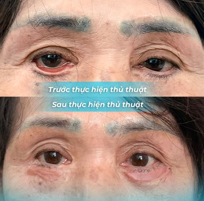 Bệnh nhân bị lật mi dưới hai bên mức độ nặng, mi mắt không áp sát nhãn cầu, kèm viêm kết mạc. Ảnh: BVCC.