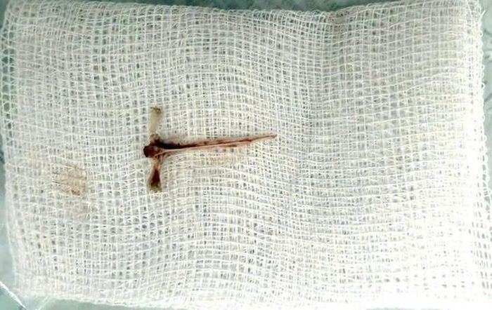 Dị vật là mảnh xương cá hình chữ T kích thước 1,5 x 2 cm. Ảnh: BV cung cấp.
