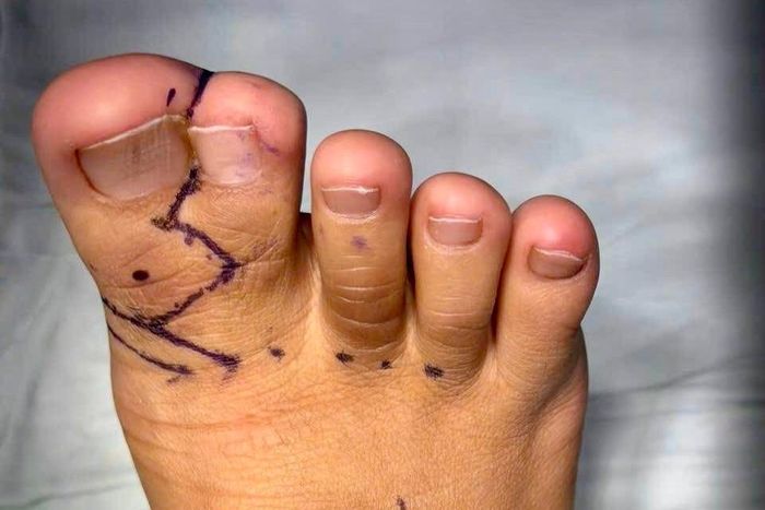 Ca phẫu thuật ứng dụng kỹ thuật tạo hình tiên tiến