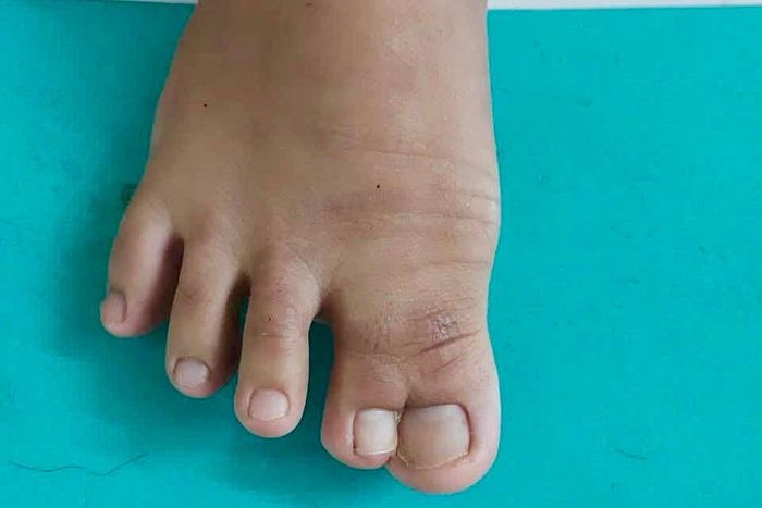Trước phẫu thuật, bàn chân phải của bệnh nhi dính hoàn toàn ngón chân cái (ngón I) và ngón thứ II dạng màng
