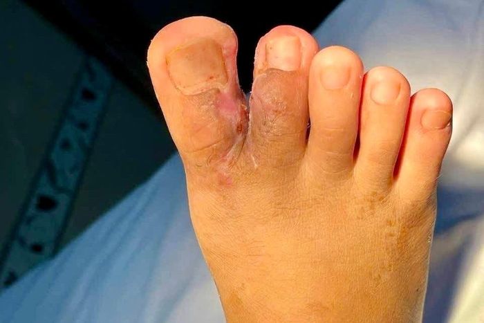 Bàn chân của bệnh nhi sau khi phẫu thuật thành công