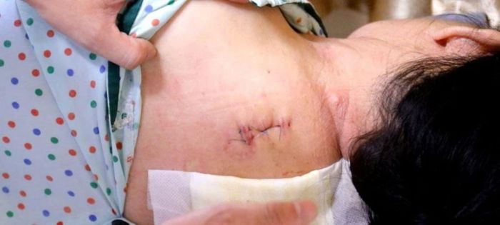 Vết mổ nhỏ sau phẫu thuật u tuỷ ngực, xâm lấn tối thiểu. (Ảnh: BVCC)