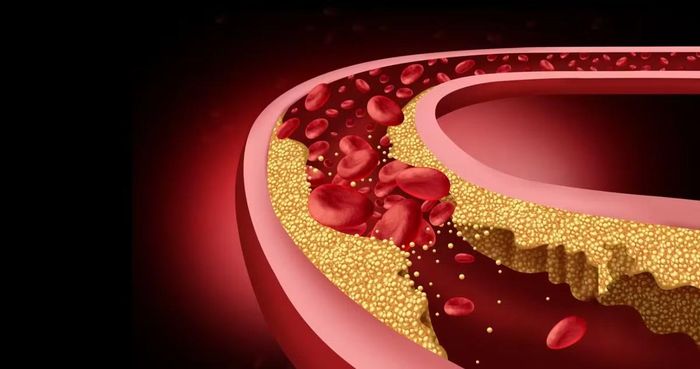 Cholesterol là thủ phạm chính gây xơ vữa động mạch, tắt nghẽn mạch máu.