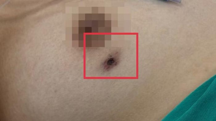 Bệnh thường khởi phát bằng những triệu chứng khá phổ biến như sốt cao, đau đầu, mệt mỏi, đau nhức cơ thể; một số người có thể phát ban. Vì vậy, ở giai đoạn đầu, bệnh dễ bị nhầm với các bệnh nhiễm trùng khác. Ảnh: Bệnh viện cung cấp