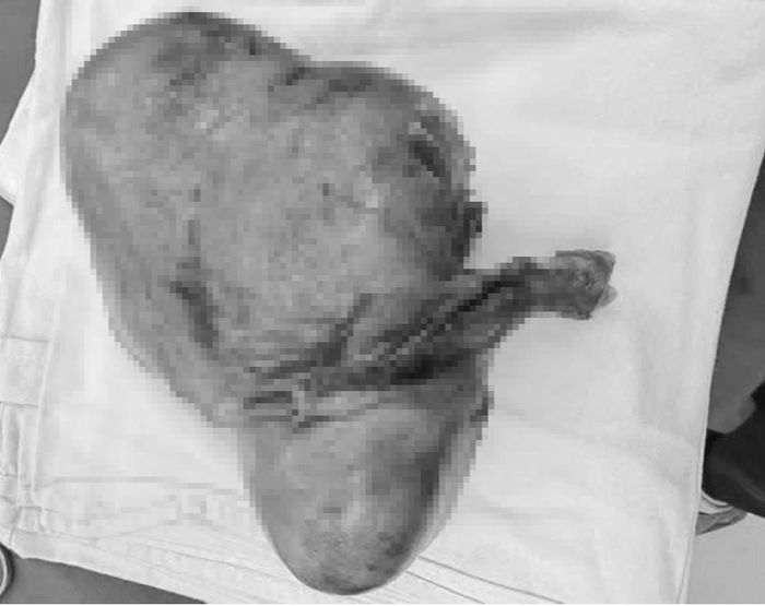 Khối u với đường kính khoảng 20cm, nặng 1,5kg được ê-kip các bác sĩ đưa ra khỏi cơ thể người bệnh