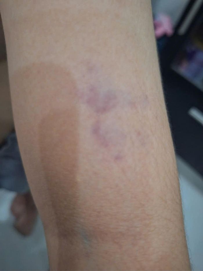 Vết bầm trên cơ thể cháu K.N sau khi bị các bạn đánh trong giờ ra chơi. Ảnh: Gia đình cung cấp
