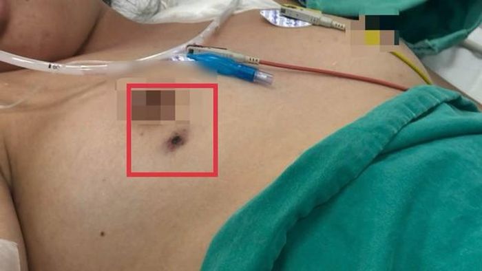 Vết mò đốt ở vùng ngực bệnh nhi. Ảnh: BVCC. 