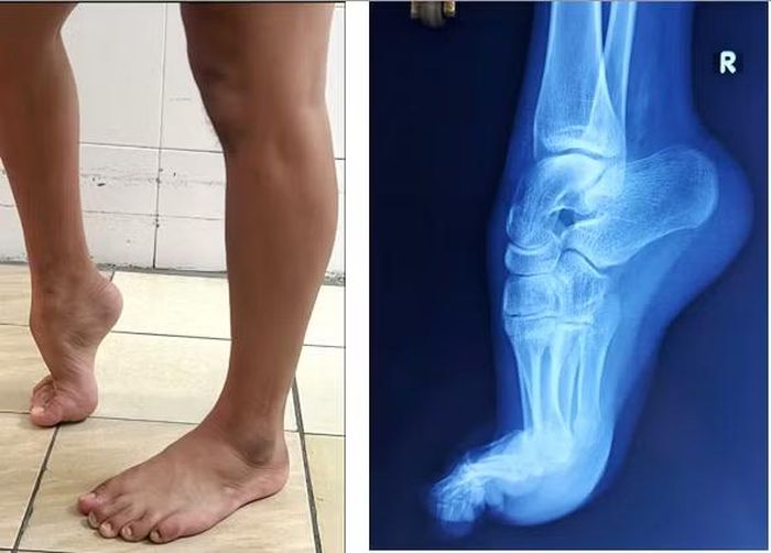 Hình ảnh lâm sàng và X-Quang trước điều trị ca biến dạng bàn chân thuổng chân phải.