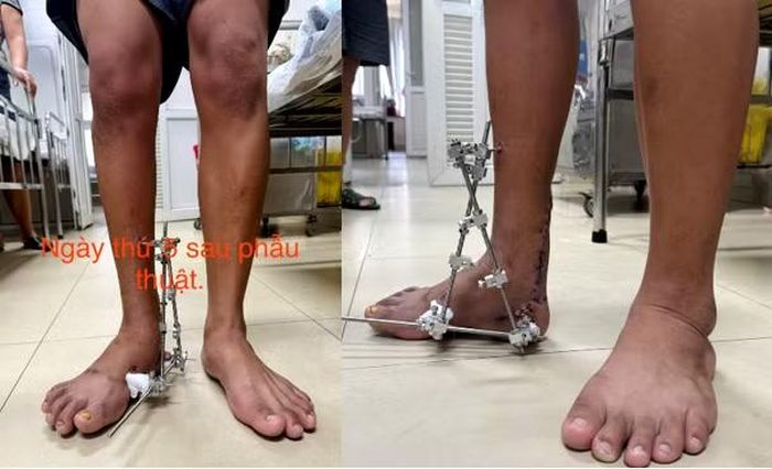 Bàn chân của bệnh nhân đã tiếp xúc với mặt đất sau 21 năm từ lúc sinh ra. (Ảnh: Bệnh viện cung cấp).