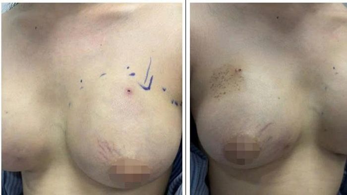 Cô gái 24 tuổi bị áp xe hai bên vú.
