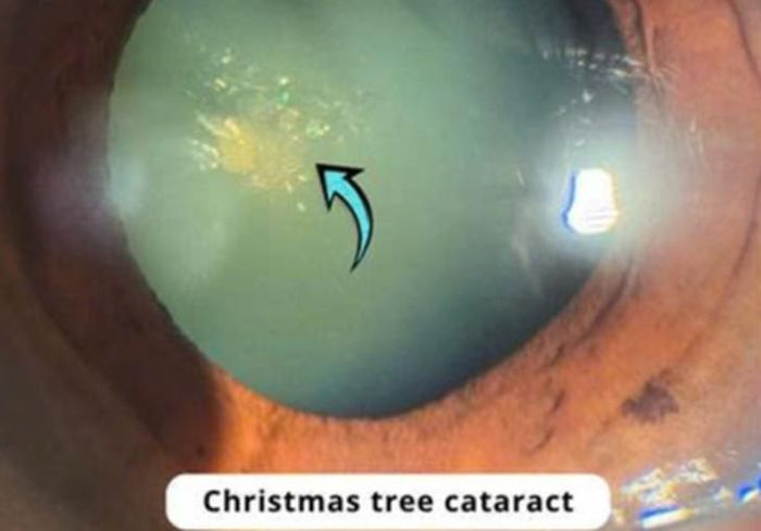 Đục thuỷ tinh thể hình cây thông Noel. Ảnh: BVCC.