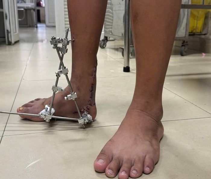 Hình ảnh bàn chân chàng trai trước và sau phẫu thuật. Ảnh: BSCC.