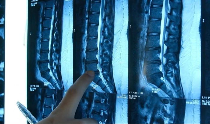 Thoát vị đĩa đệm - bệnh lý ảnh hưởng nghiêm trọng tới sức khỏe. Ảnh: Hoa Linh.