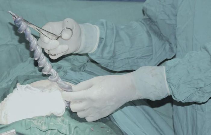 Dây rau căng to và tím đen là hậu quả của suy tim gây ứ máu và sự nối thông động - tĩnh mạch (Shunt) trong u máu bánh rau khiến máu không được trao đổi khí cacbonic và oxy làm máu tĩnh mạch rốn có màu đen. Ảnh: BVCC.