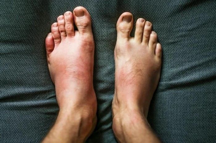 Sưng phù, đặc biệt ở chân, mắt cá chân, là triệu chứng khá điển hình của bệnh thận. Ảnh: Pexels.