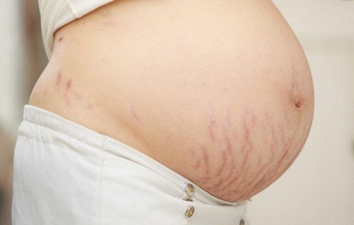 Rạn da hình thành khi da bị kéo giãn nhanh, gây tổn thương các sợi collagen và elastin ở lớp trung bì.
