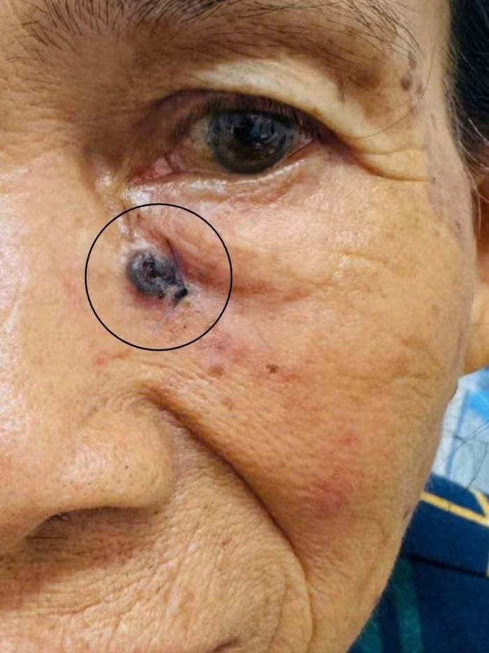 Vết loét lâu ngày trên da được xác định là ung thư biểu mô tế bào đáy - Ảnh BVCC