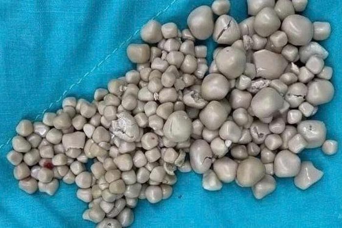 Sỏi thận có thể tồn tại âm thầm trong thời gian dài trước khi gây đau dữ dội hoặc các biến chứng, khiến nhiều người chỉ phát hiện bệnh khi viên sỏi đã lớn. Ảnh: Trung tâm Y tế Chi Mei/Straits Times.