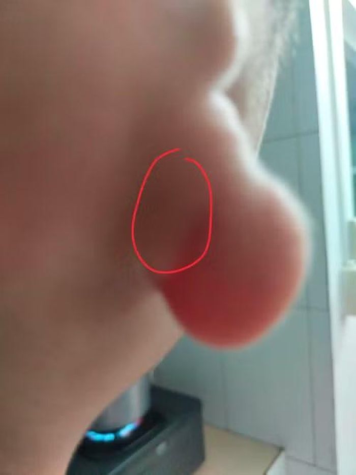 Vành tai bệnh nhi nhỏ nghiêm trọng, gần như không có cấu trúc vành tai bình thường.