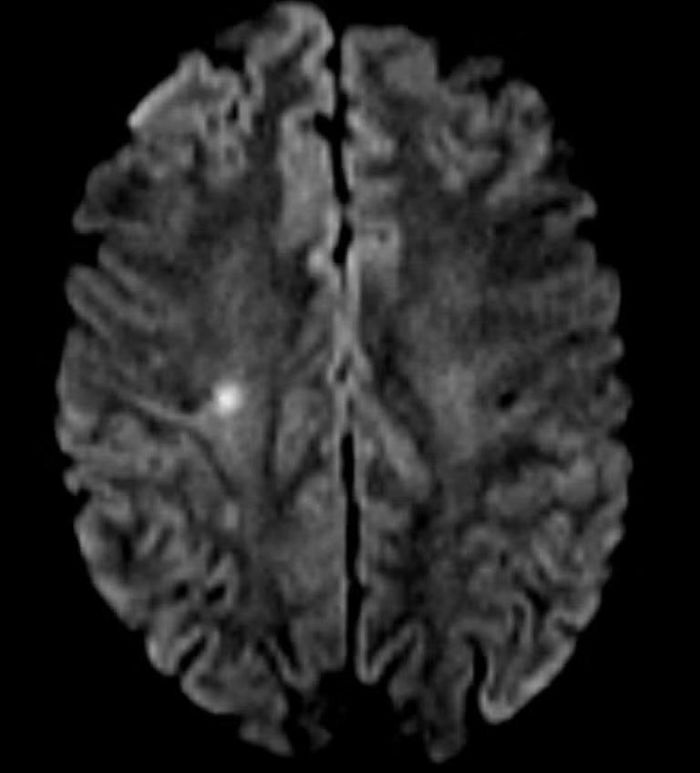 Hình tổn thương não trên phim MRI của bệnh nhân bị đột quỵ khi đang du lịch - Ảnh BVCC