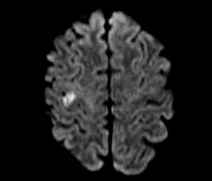 Hình tổn thương não trên phim MRI của bệnh nhân bị đột quỵ khi đang du lịch - Ảnh BVCC
