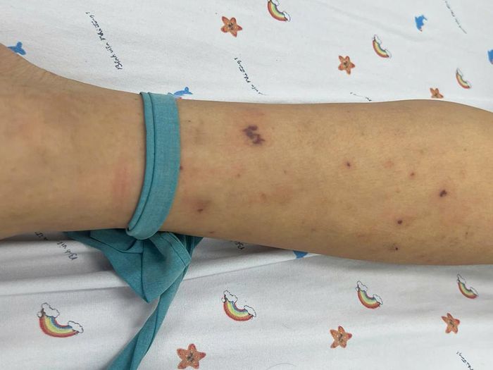 Vết tử ban do não mô cầu trên chân của nam thiếu niên H.T.T.Đ., 14 tuổi. Ảnh: BSCC
