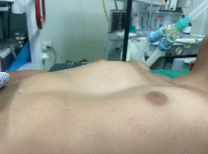 Lõm ngực bẩm sinh là dị dạng phổ biến nhất ở thành ngực trẻ em. Ảnh BV