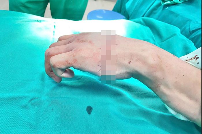 Sau ca phẫu thuật, bàn tay người bệnh phục hồi. Ảnh: BVCC