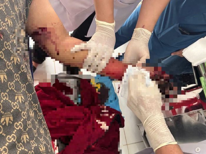 Bàn tay thiếu niên 16 tuổi dập nát do điện thoại phát nổ trong lúc sạc pin.