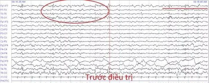 Hình ảnh điện não đồ trước điều trị - Ảnh BVCC