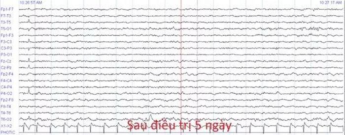 Hình ảnh điện não đồ sau điều trị - Ảnh BVCC