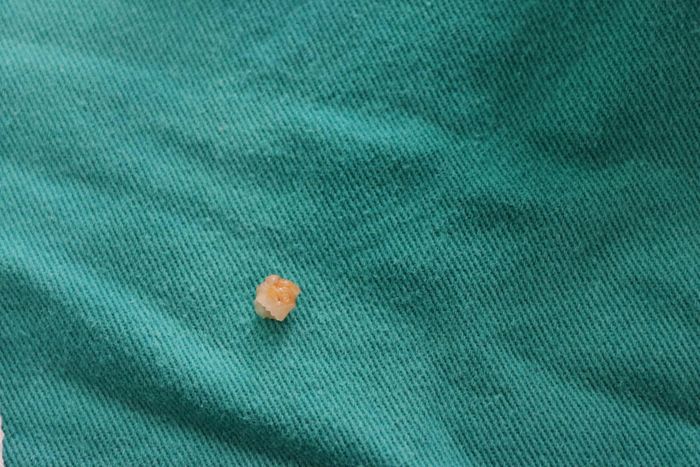 Một phần răng sâu được lấy ra sau khi nội soi phế quản cho bệnh nhi 6 tuổi (Ảnh: Bệnh viện Bạch Mai).